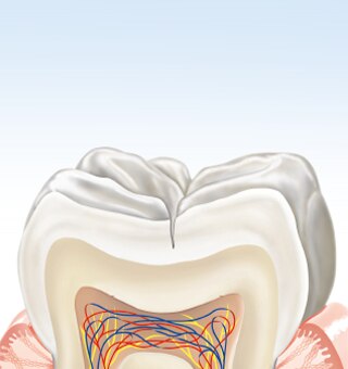 Как се образува зъбният кариес?